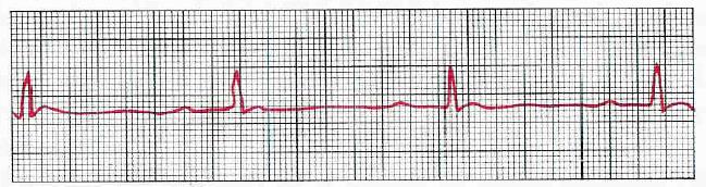 Sinusová bradykardie SINUS BRADYCARDIA Impuses originate at S-A