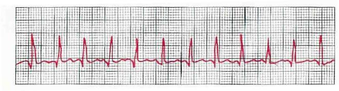 Sinusová tachykardie SINUS TACHYCARDIA Impuses originate at S-A