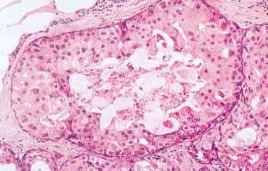 Vývoj karcinomů prsu DCIS G1 DCIS G2 DCIS G3 TDLU terminal ductulo-lobular unit UDH ADH Byla popsána kaskáda