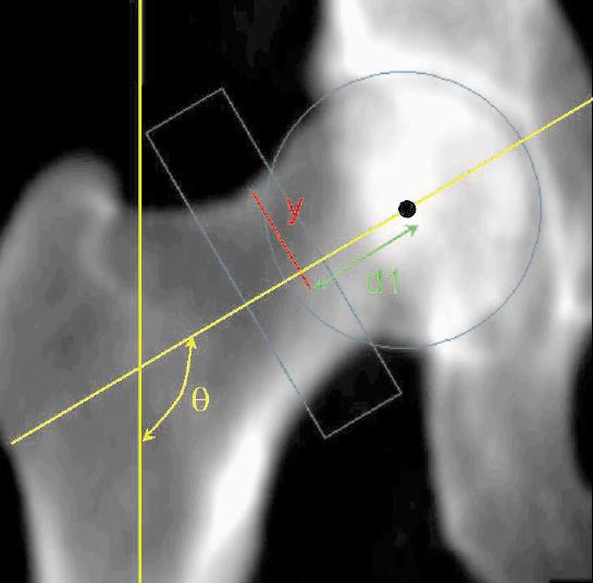 HAL Hip Axis Lenght Signifikantně prodloužen u nemocných s frakturou Predikce fraktur