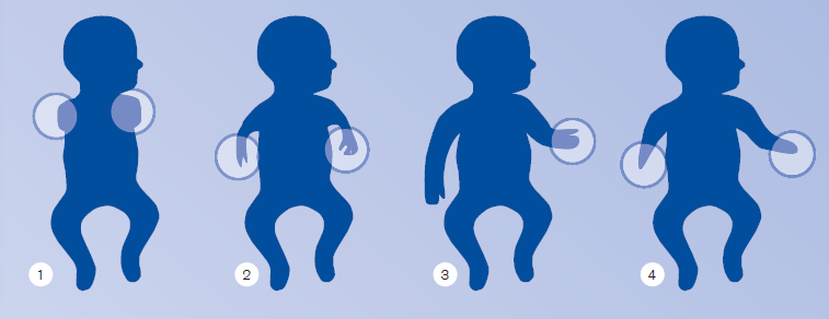 3.3 Vybavení protézou V případě vrozené vady má velký význam pro vývoj kojence přiměřené vybavení již od 6. měsíce.