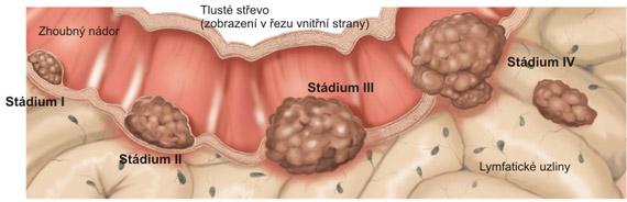 Pokud je v jednom z těchto adenomů aktivován protoonkogen K-ras, může takový adenom dále růst a vyvíjet se.