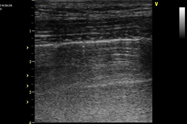 Hrudní UZ jako doména intenzivní péče 1.) Pleurální tekutina: fluidothorax adheze a pyothorax hemothorax 2.) Drenáž pod UZ a verif.