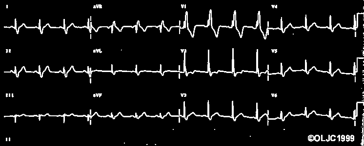 Blok pravého raménka kompletní QRS nad 0,12 s typické svody