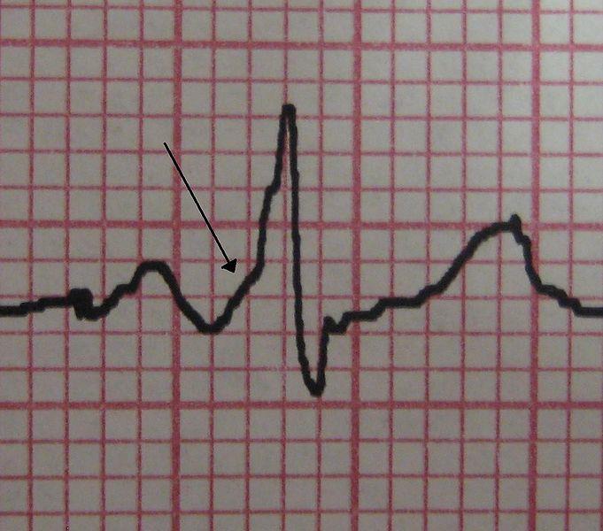 Syndrom preexcitace WPW (Wolf-Parkinson-White) síňokomorová tachykardie