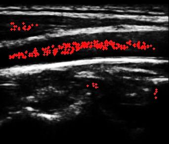 42 /18 /52 SPLAB, BUT Klepnutím PROPOSED lze RANSAC-BASED upravit styl METHOD předlohy Classification Post-processing Sampling, feature extraction SVM classifier Artery points selection Proposed