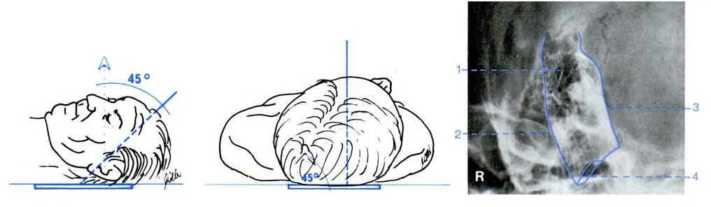 3.4.2 Stenversova projekce Pacient je opět v pronační poloze, hlava je otočena o 45 vyšetřovanou stranou blíže k rentgence, laterální hrana orbity nevyšetřované strany naléhá na desku stolu.
