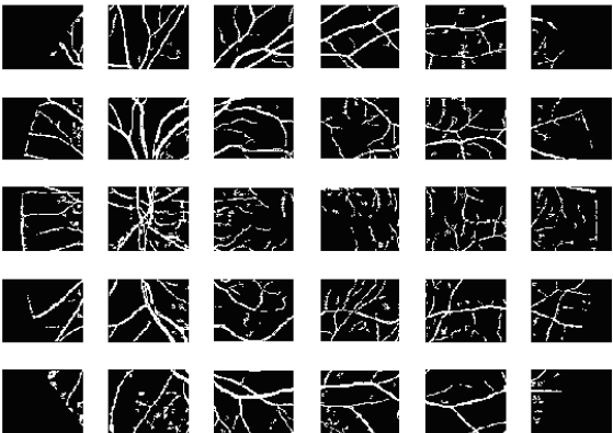 Protože fragmenty jsou normovány od hodnoty 0 255 úrovní jasu a cévy patří mezi nejsvětlejší objekty v obraze, jsou zvoleny prahy 140 a 220. Obrázek č.