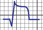 Abychom dobře porozuměli, jak nám EKG může pomocí s identifikací infarktu, je potřeba si uvést několik údajů.