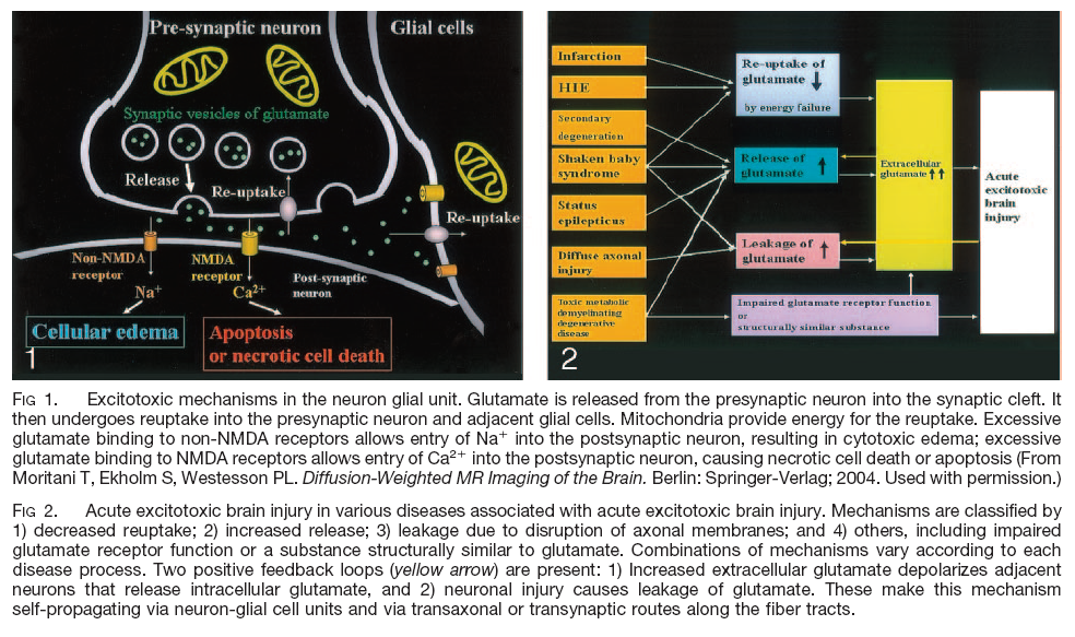 Sekundární mozkové poškození Excitační neurotransmitery (glutamát) Zvýšení Ca intracelulárnně Kyslíkové radikály,