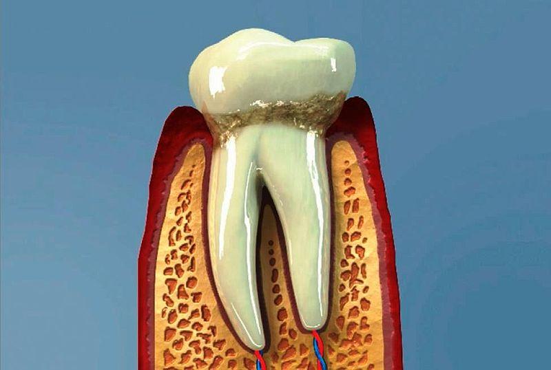 ZÁNĚT DÁSNÍ = GINGIVITIDA obrana těla před toxiny bakterií v ústní dutině, podpora vznikem zubního kamene, krvácení z