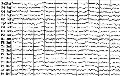 EEG signál příklad