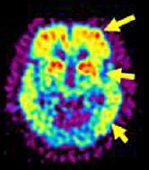 Celoživotní fyzická aktivita a amyloid