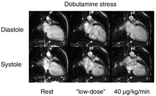 stress cardiac imaging zátěžová echokardiografie perfuzní