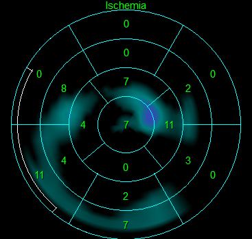 D-SPECT - ischemia