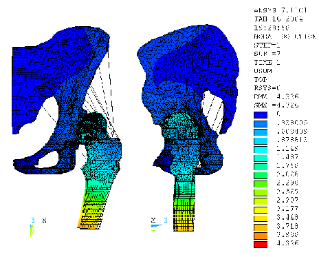 ] 61,825 28,403 93,301 [N] 735,750 [1] 4,461 2-D analytický výpočet na úrovni silových výslednic: FR = 3307 N FS = 2737 N Pokud není v modelu zatížení uvažována tíha dolní končetiny