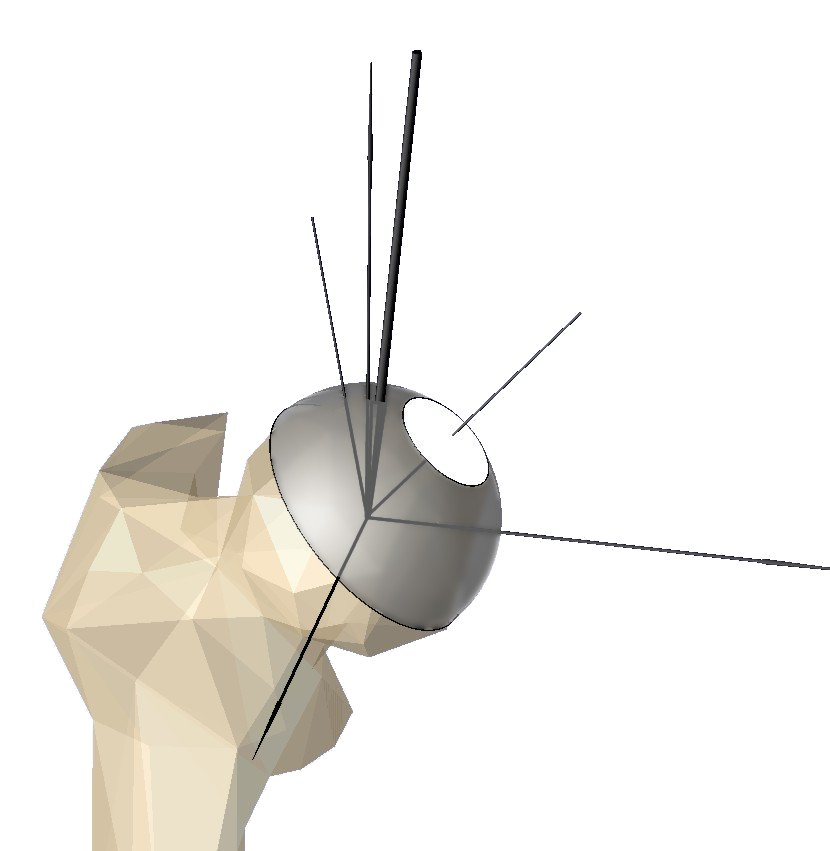 Aseptická nekroza hlavice femuru Kontaktní tlak biomechanický parameter Verifikace z y anterior Θ P superior R ϑ R ϑ N N ϑ x medial p / W max B [kpa/n] 7. 6. 5. 4. 3. 2.