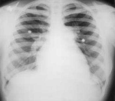 RTG diagnostika (chronické) plicní hypertenze RTG šíře