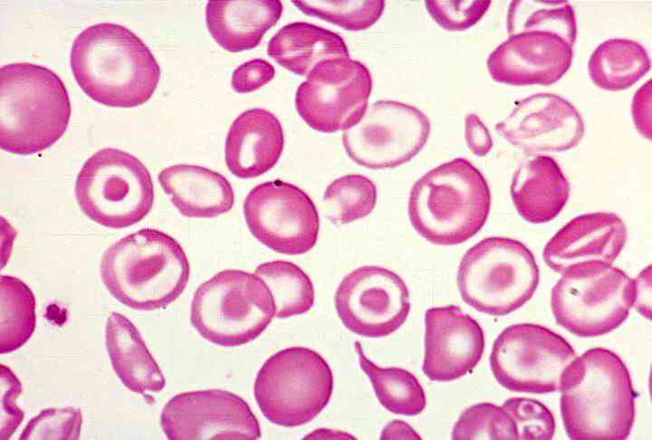THALASÉMIE 2/ (Cooley s anemia, Mediterranean anemia ) Heterozygotní formy většinou (tj. minor, event.