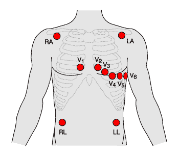 2.1.5 EKG Slouží k určení tepové frekvence a k záznamu křivky před, během i po zátěži.