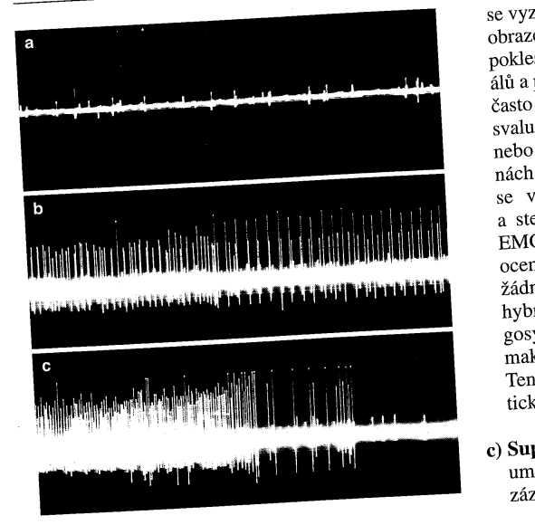 abdukci oka (2) Obrázek 34: Periferní neurogenní obrna m. r. int.: A - při úplné obrně el.