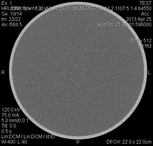 SKEN č. 2 Vyšetřovaná oblast: Hrudník Pouţitá matice: 512x512 Nastavení napětí: 120 kv Nastavení proudu: 75 ma (CARE DOSE) Efektivní dávka: 3,3 msv Obr.