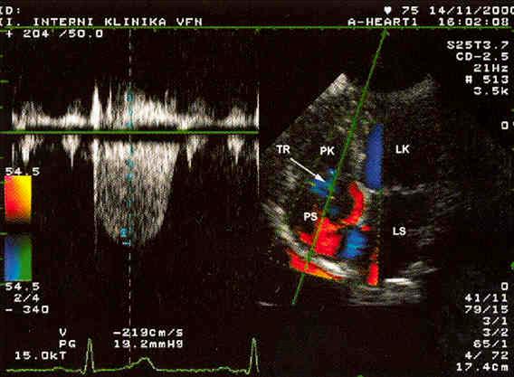 Plicní hyeprtenze = PASP nad 35mmHg dopler: trikuspidální regurgitace gradient nad (25)-30mmHg pulmonary systolic arterial pressure (PASP)= Trik reg gradient+ tlak v