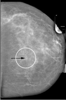 Klasifikace RTG/MRI Mamografie Určení typu nalezených lézí Popis