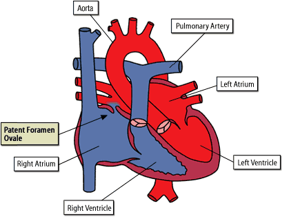 AMPLATZER PFO OCCLUDER PFO Patent foramen