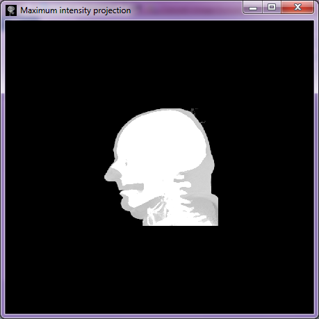 Maximum intensity projection Tato metoda zobrazuje pouze nejjasnější struktury podél paprsku.