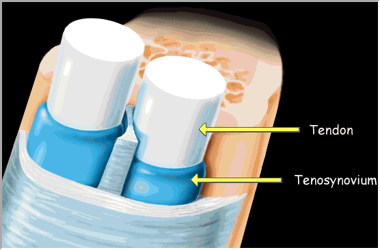 Přetížení šlach - synovitidy opakované pohyby tření v úzkém prostoru =