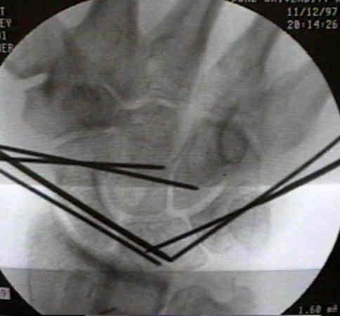 Perilunární luxace - zavřená repozice a transfixace KW Fixace :