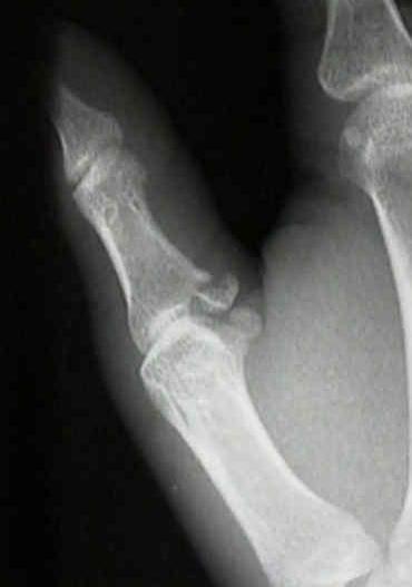 Lyžařská zlomenina palce avulzní fraktura baze