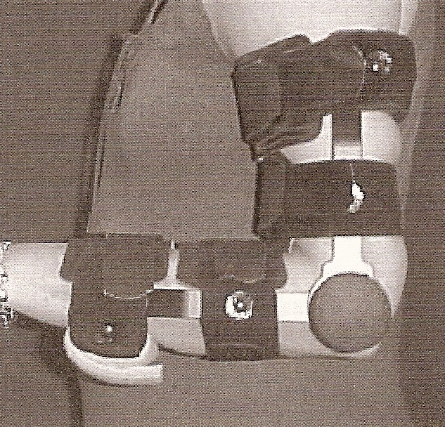 Obr. 27 Bledsoe brace imobilizující loket v 45 flexi (Coppard a Lohman, 2008, s. 216) Obr. 28 Mayo elbow universal brace imobilizující loket v 90 flexi (Coppard a Lohman, 2008, s.