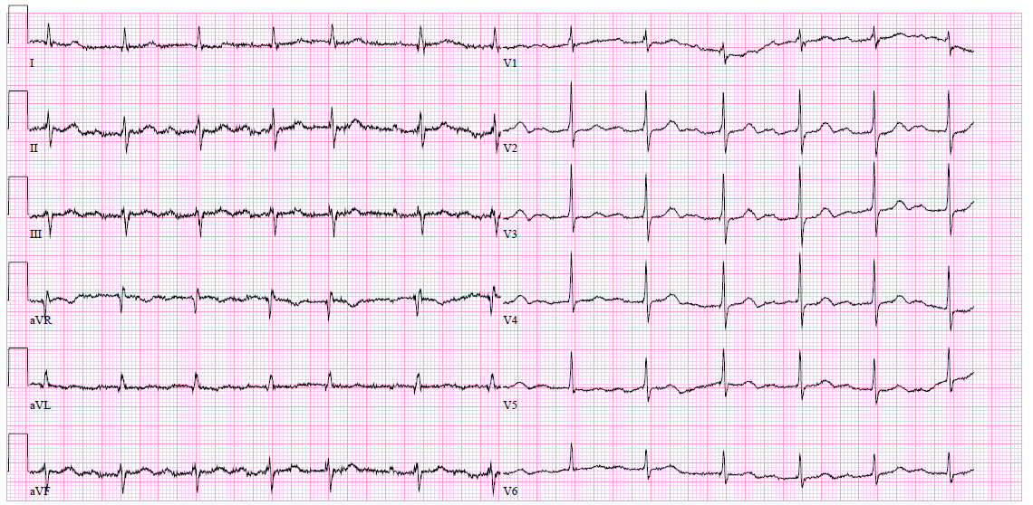 norm. EF LK, TriR R 3-4/5, odhad RVSP 60-70 mmhg, nedávno zahájena diur. terapie art. hypertenze parox. FiS, t.č.