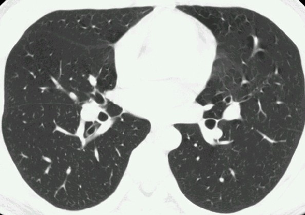 High resolution CT (HRCT) detailní obraz plicního parenchymu bronchovaskulární kresba bronchioly