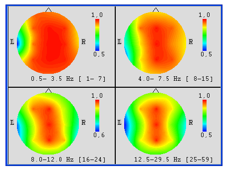 6.Zobrazeí výsledů spetrálí aalýzy a) b) c) Obr 5: a) Loálí oherece b) Iterhemsferálí oherece c) souhr terhemsferálích map pro edotlvé frevece Topografcé mapováí fáze Podobě lze mapovat taé fázové