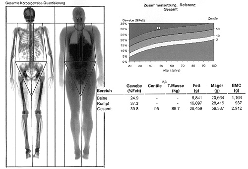 Dvoufotonová rtg absorpční fotometrie (DEXA-Dual Photon X-ray