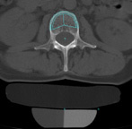 Kvantitativní počítačová tomografie QCT- Quantitative CT CT kalibrovaný pomocí fantomu modelu kosti s přesně definovanou hustotou.