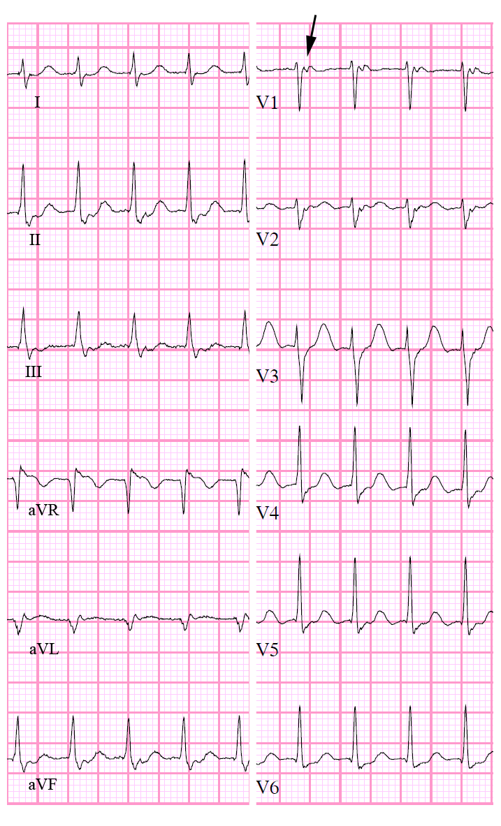 AVNRT EKG