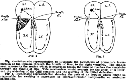 1930 description of WPW syndrom: Přídatné dráhy short PR, bundle block and paroxysmal