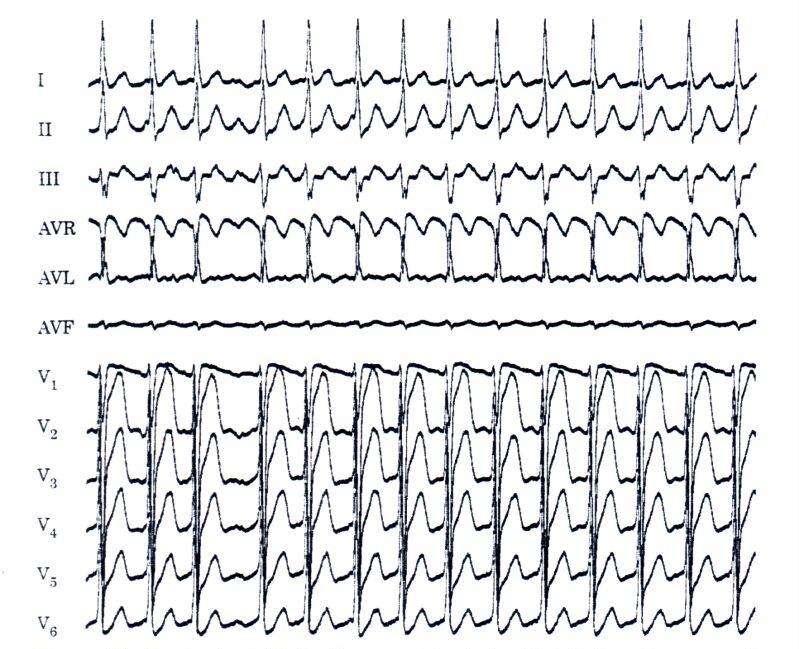 CCW vs CW flutter CCW flutter je 10x častější V EKG zuby pily ve spodních svodech CW flutter