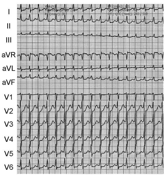 AV nodální reentry tachy Výskyt: 60% paroxysmálních SVT Epi: 2/3 ženy, středním věku EKG: štíhlé QRS komplexy bez P vln frek.