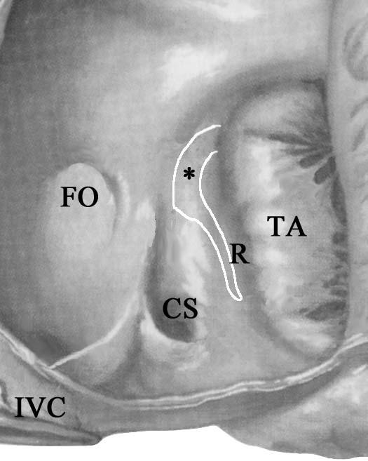 AVNRT patofyziologie - anatomie Dualita AV vedení