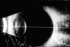 jednotlivých obrazů je podmíněn elektronickým nebo mechanickým vychylováním svazku paprsků. B-scan vypovídá o tvaru, poloze a velikosti vyšetřované oční struktury [13].