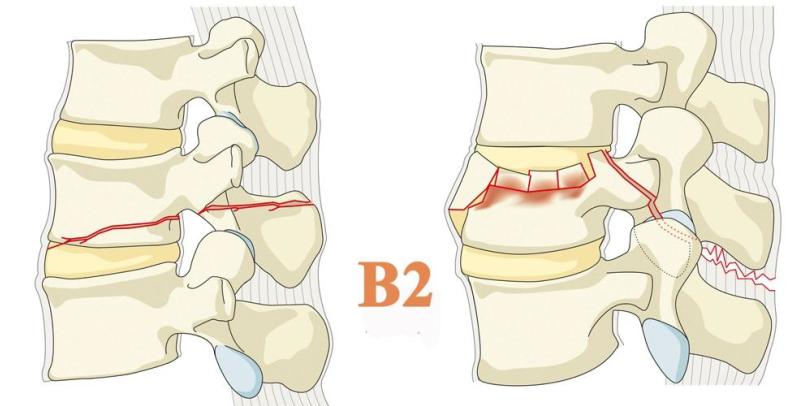 B1 - Chanceho fraktura - transoseální poranění 1 obratle B2 -