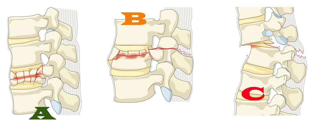 postihují pohybový segment poranění předních nebo zadních tahově-ohybových struktur bez tendence k