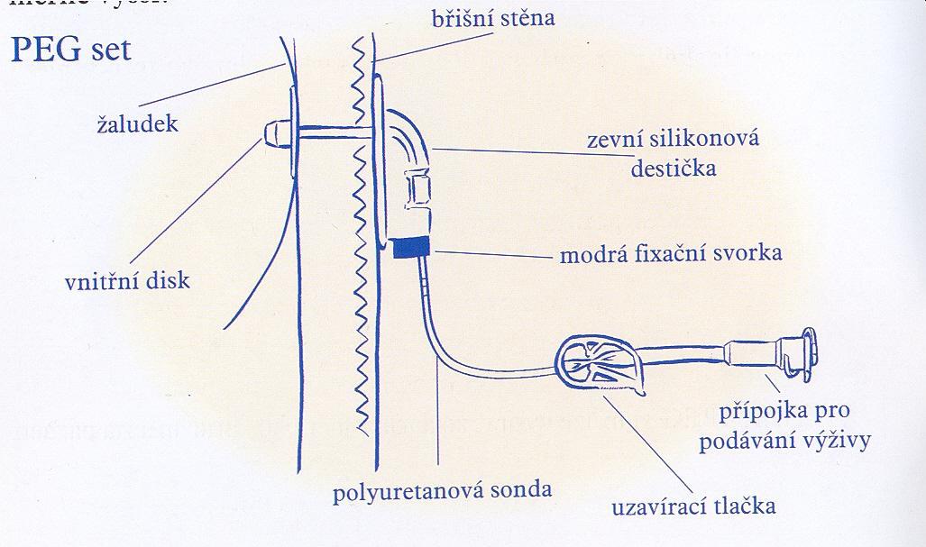 výživovou sondu, aby ony pečovaly o Vás: