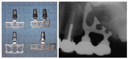 5.2 Čepelkové implantáty Název čepelkových implantátů (obr.5.2) je odvozen od jejich tvaru, který připomíná polovinu podélně rozlomené holící čepelky.