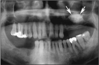 Obr. 7.4: Sinus lift postup augmentace[23] Obr. 7.5: Šipky naznačující provedení metody sinus lift[15] 7.3.2 Augmentační materiály Nabízí se několik možností augmentačních materiálů jejich volba závisí na místě, rozsahu augmentace a stavu pacienta.